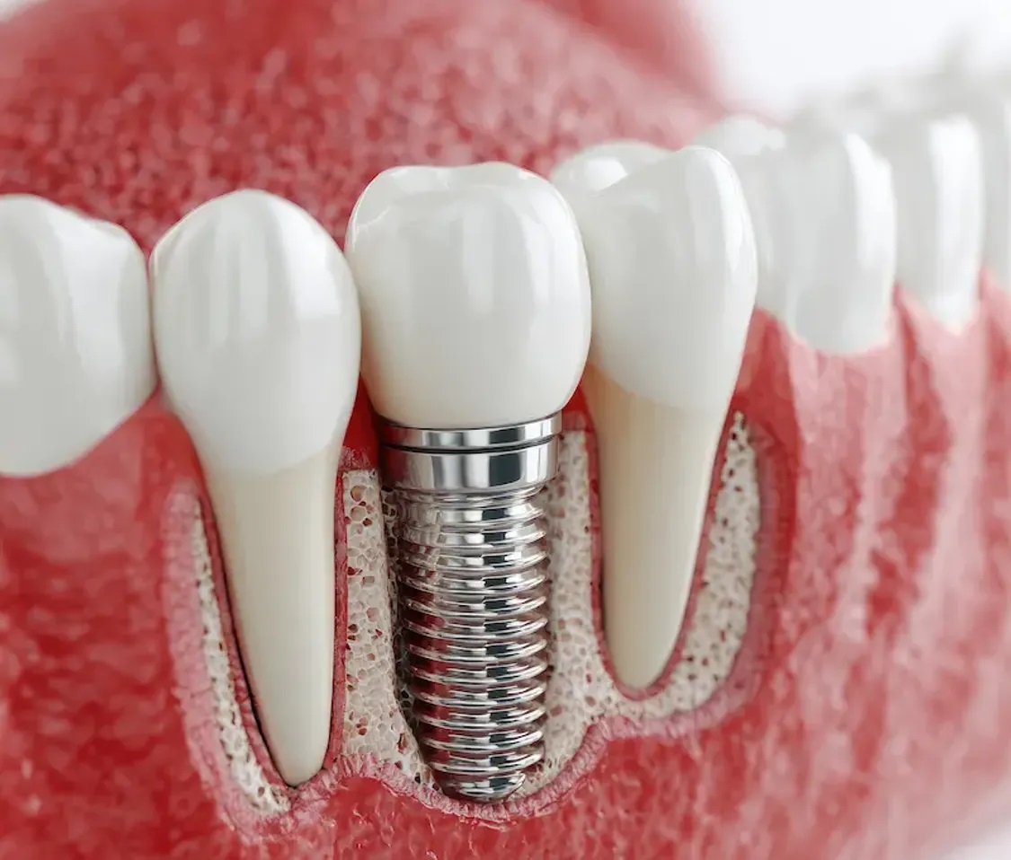 Dental Implants